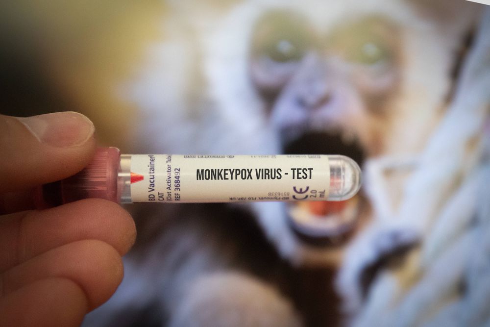 Affenpocken: 50 Mutationen bei Erreger des aktuellen Ausbruchs