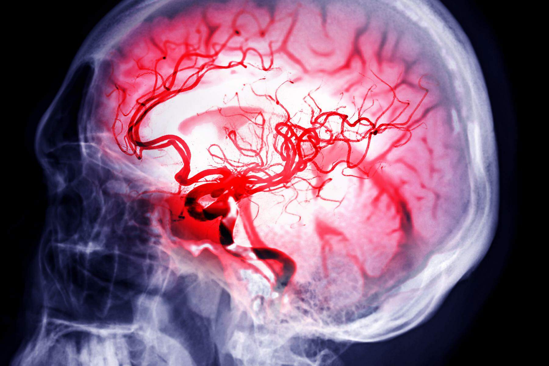 Überschwemmung im Gehirn: Wie man die Schlaganfall-Behandlung verbessern könnte